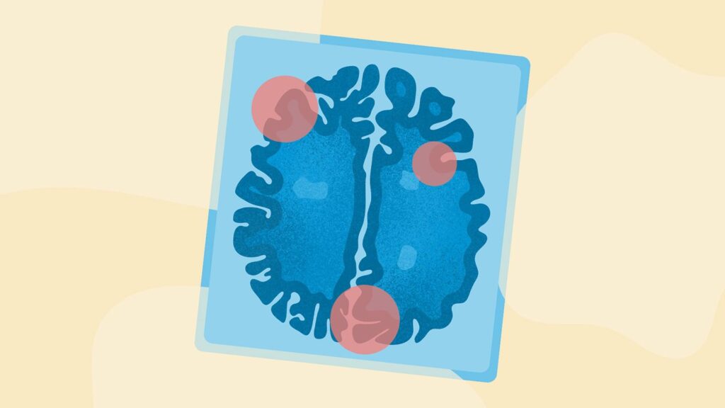 In a Bad Mood the Week Before Your Period Starts? This Hormonal Shift Could Be a Contributing Factor