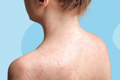Can I Get Measles if I’m Vaccinated?