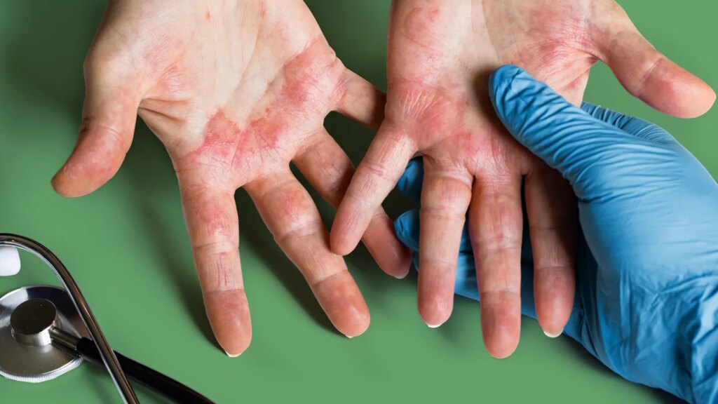 Signs It’s Time to Check on Your Atopic Dermatitis Treatment