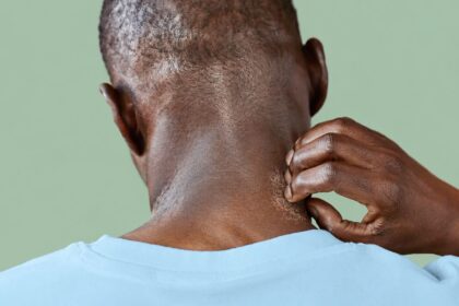 Signs of an Atopic Dermatitis Flare in Darker Skin Tones