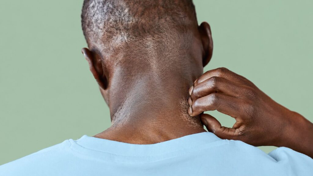 Signs of an Atopic Dermatitis Flare in Darker Skin Tones