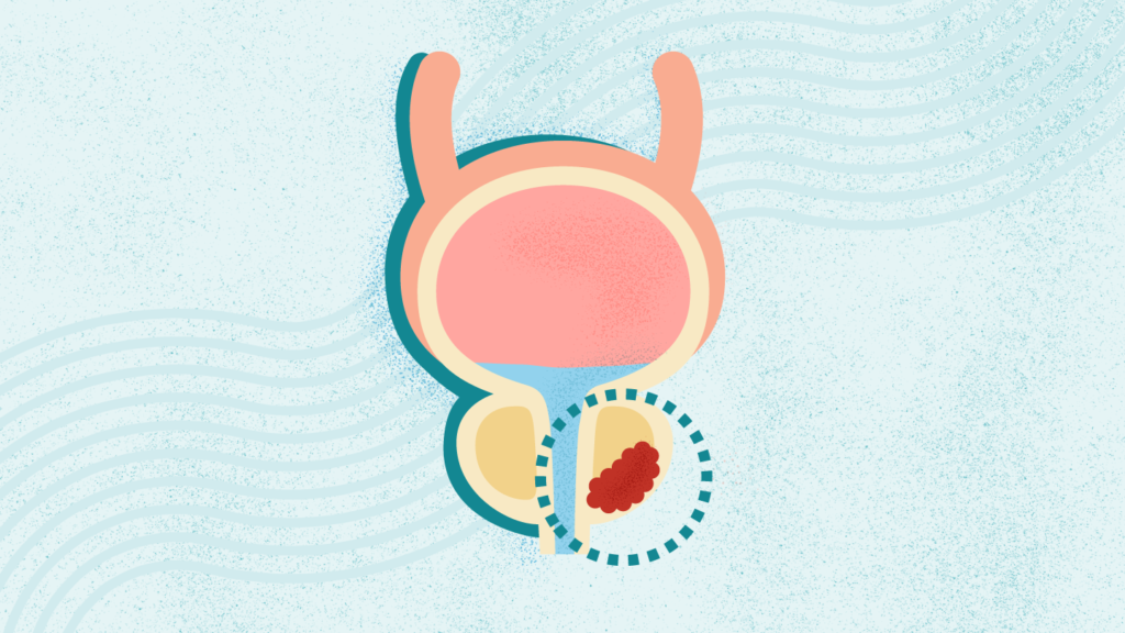 What Is Prostate Cancer?