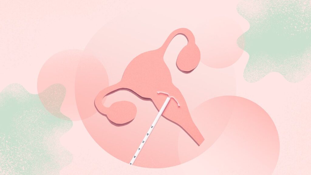 IUD Placement Can Be Less Painful With New Local Anesthesia Method, Swedish Researchers Show
